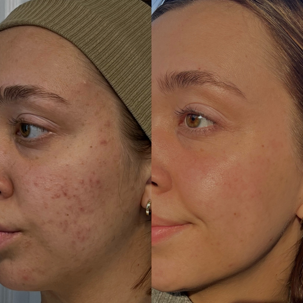 Acne bootcamp 1st Vist + Consul