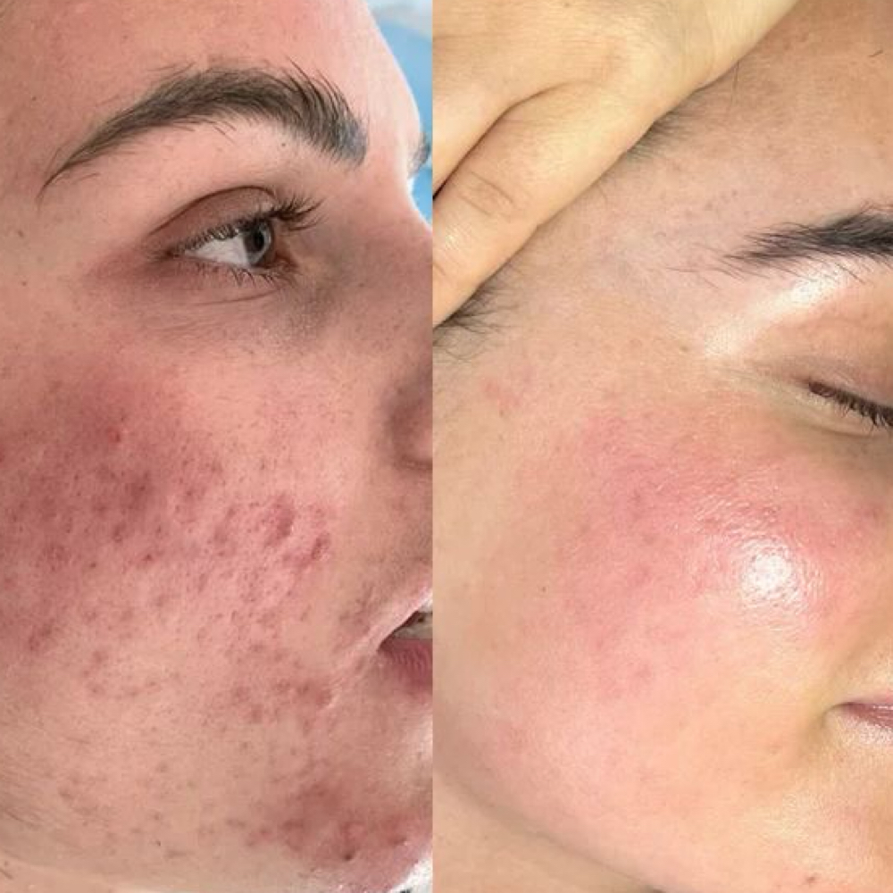 Acne Micro Needling Treatment at ILLUSIONS SALON & SPA in Warner Robins, GA