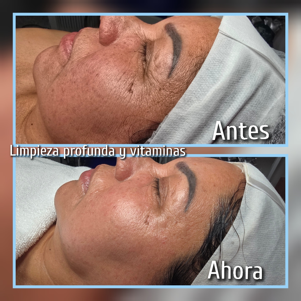Limpieza Profunda Con Células Madre