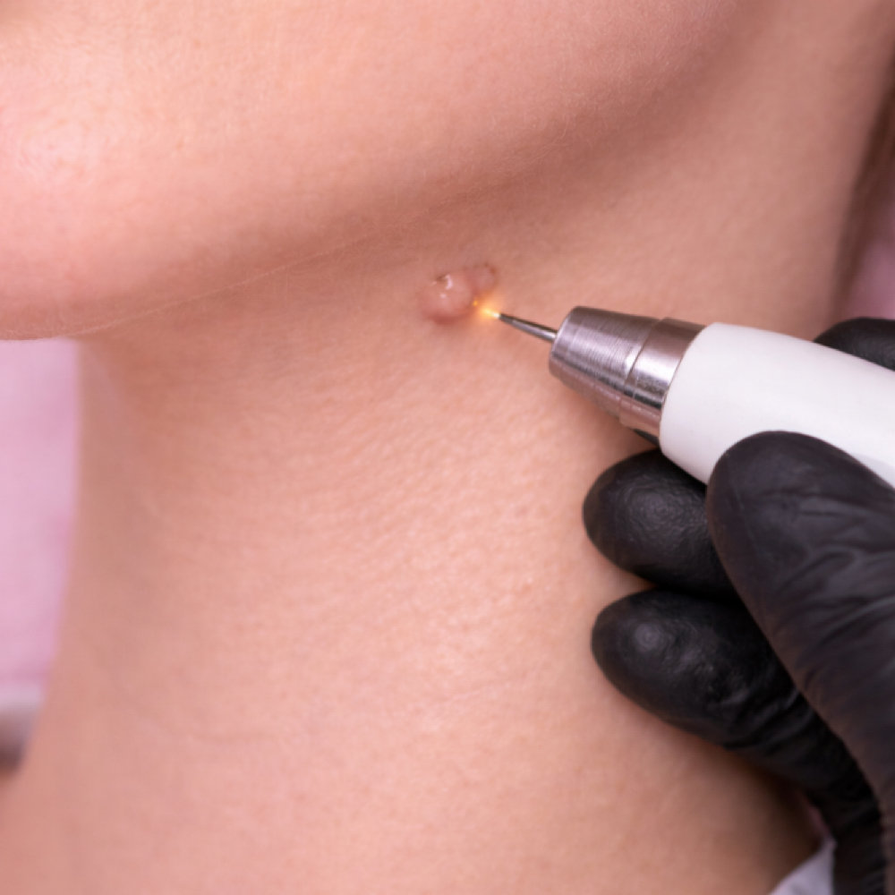 Verrugas De 20 A 30 at Beauty Couture MedSpa in Austin, TX