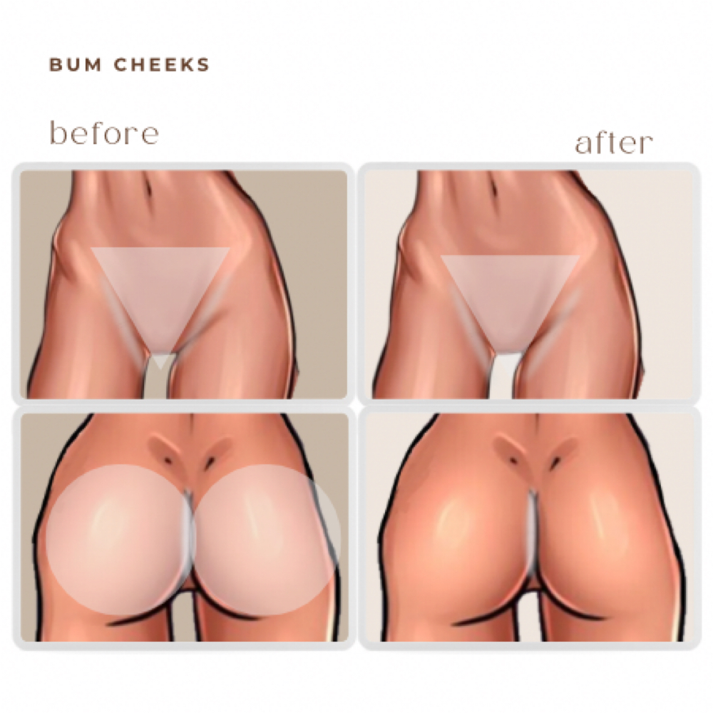 bum cheeks LASER HAIR REMOVAL at BEAUTY LAB COLLECTIVE in Miami, FL