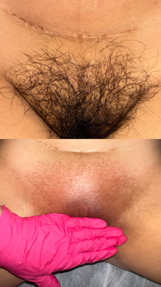 Brazilian Wax