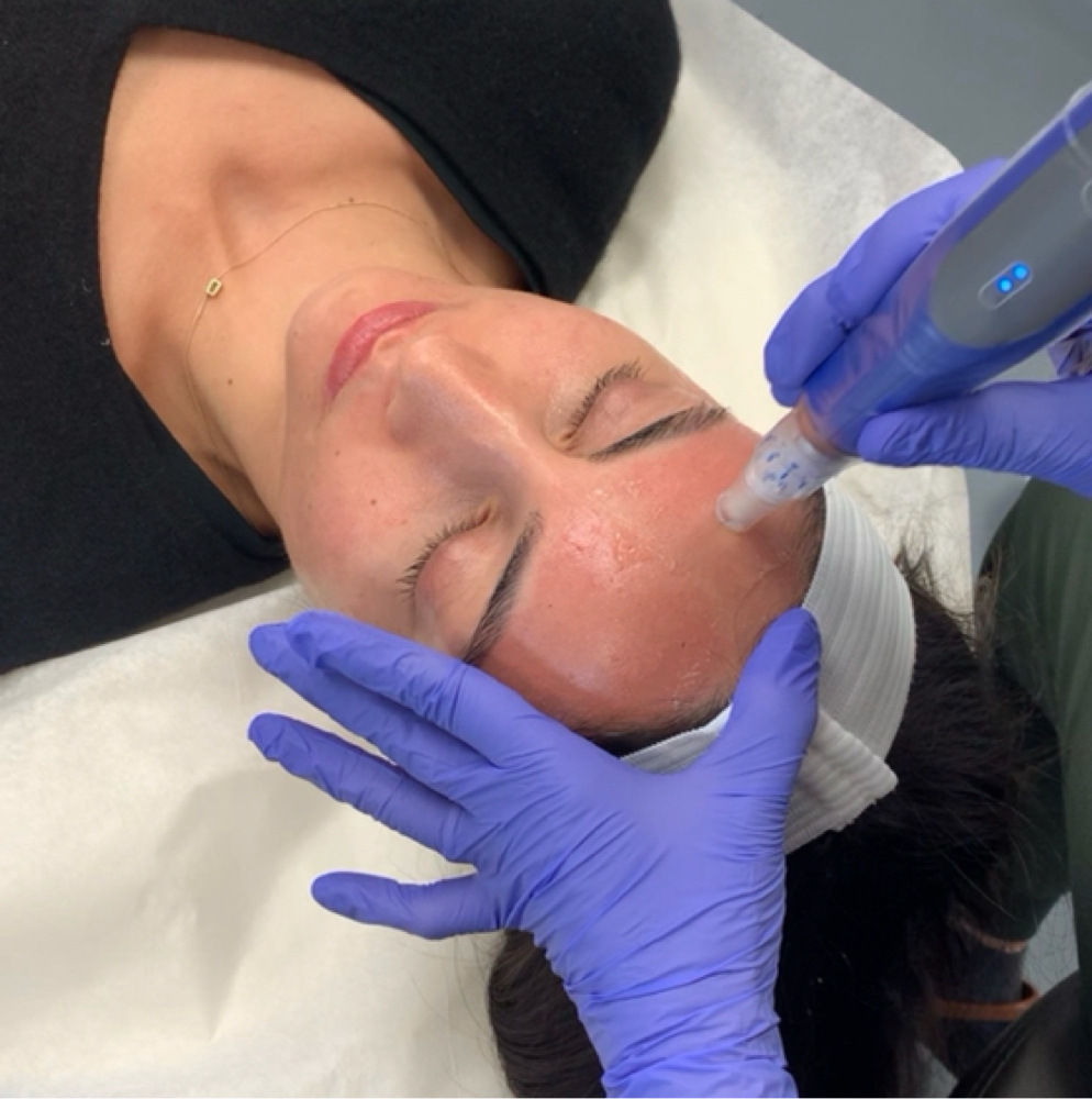 Miconeedling Neck Add On at L A BEAUTY STUDIO in Lakeway, TX