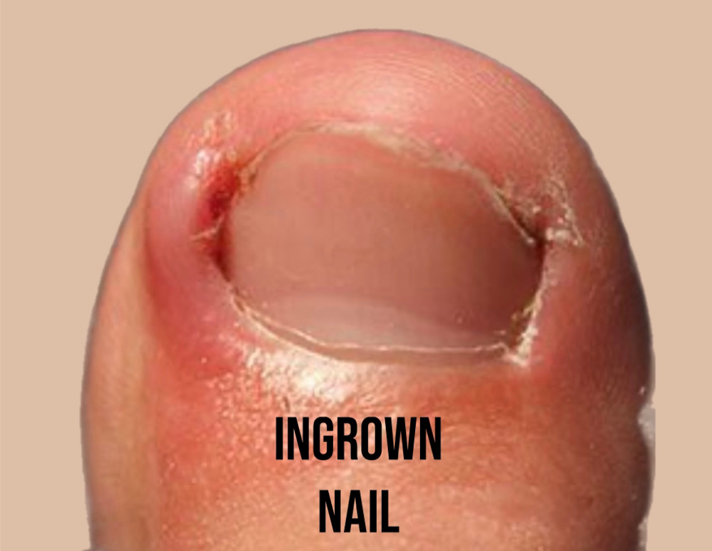 Ingrown Toenail