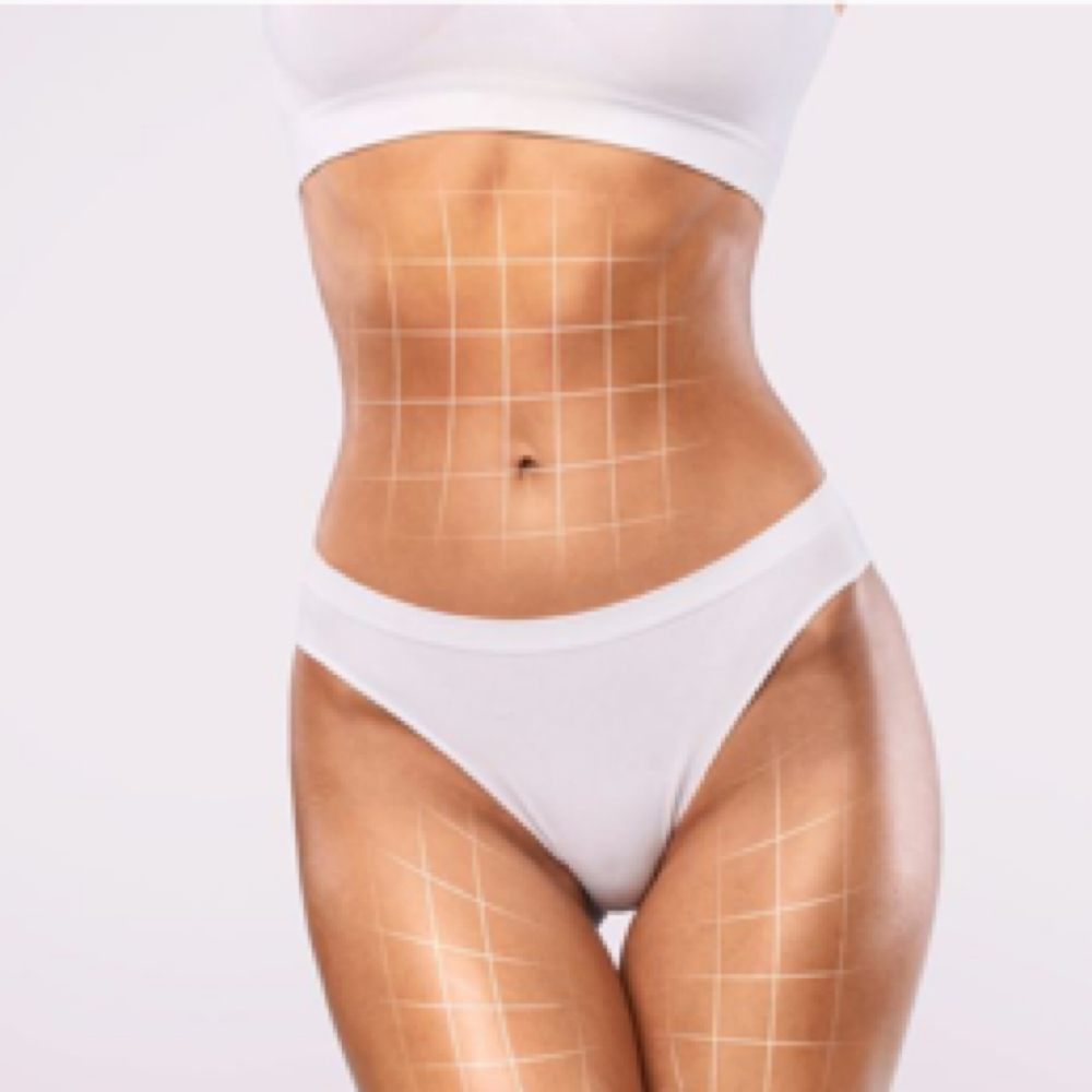 Reduction Meso therapy Consult at LM BEAUTY AESTHETICS in Everett, MA
