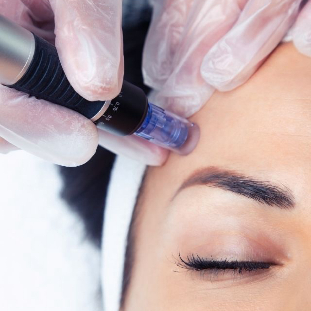 Nanoneedling at DuoGlo Esthetics in Fredericksburg, VA