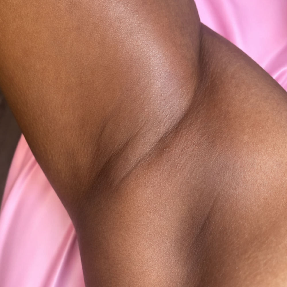 Underarm Sculpt at Ornèe Aesthetics in Plymouth, MN