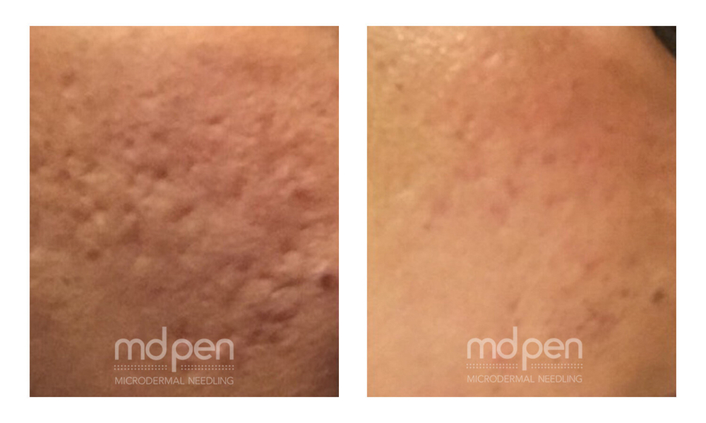 Microneedling Neck And Face