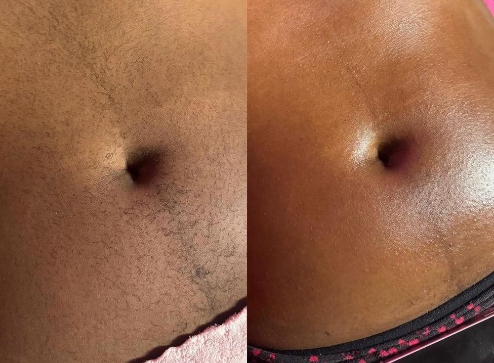 Stomach Strip Wax at Chosen Esthetics in Pasadena, TX