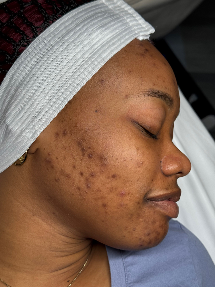Clase Hiperpigmentacion Y Melasma
