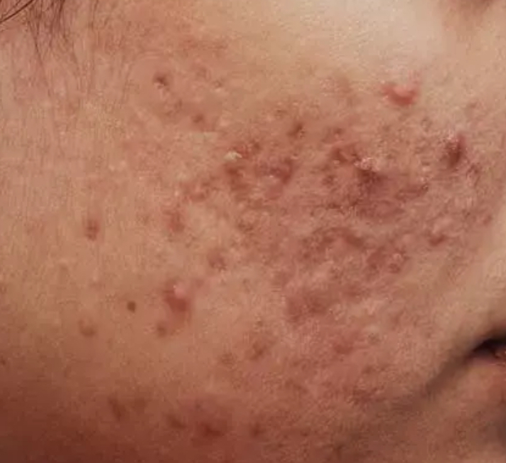 ACNE FACIAL Customized