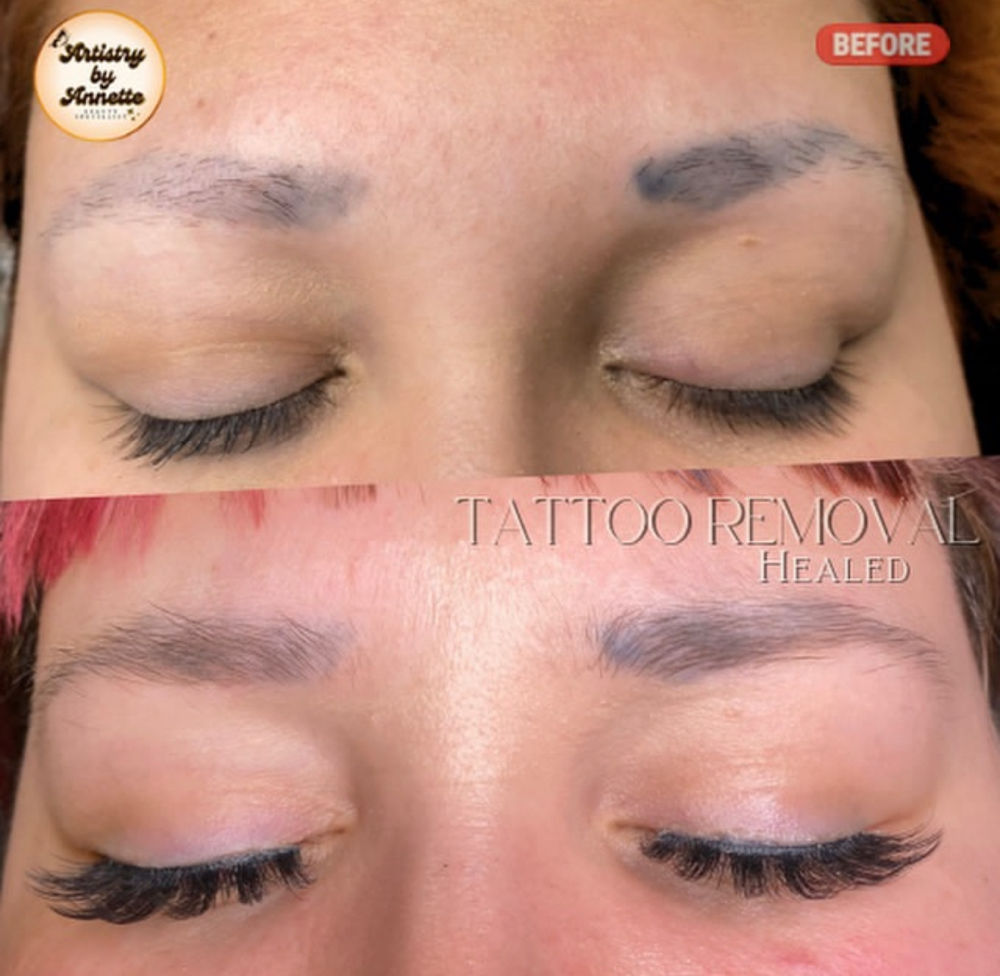 Brow Tattoo removal at Artistry by Annette in Fresno, CA