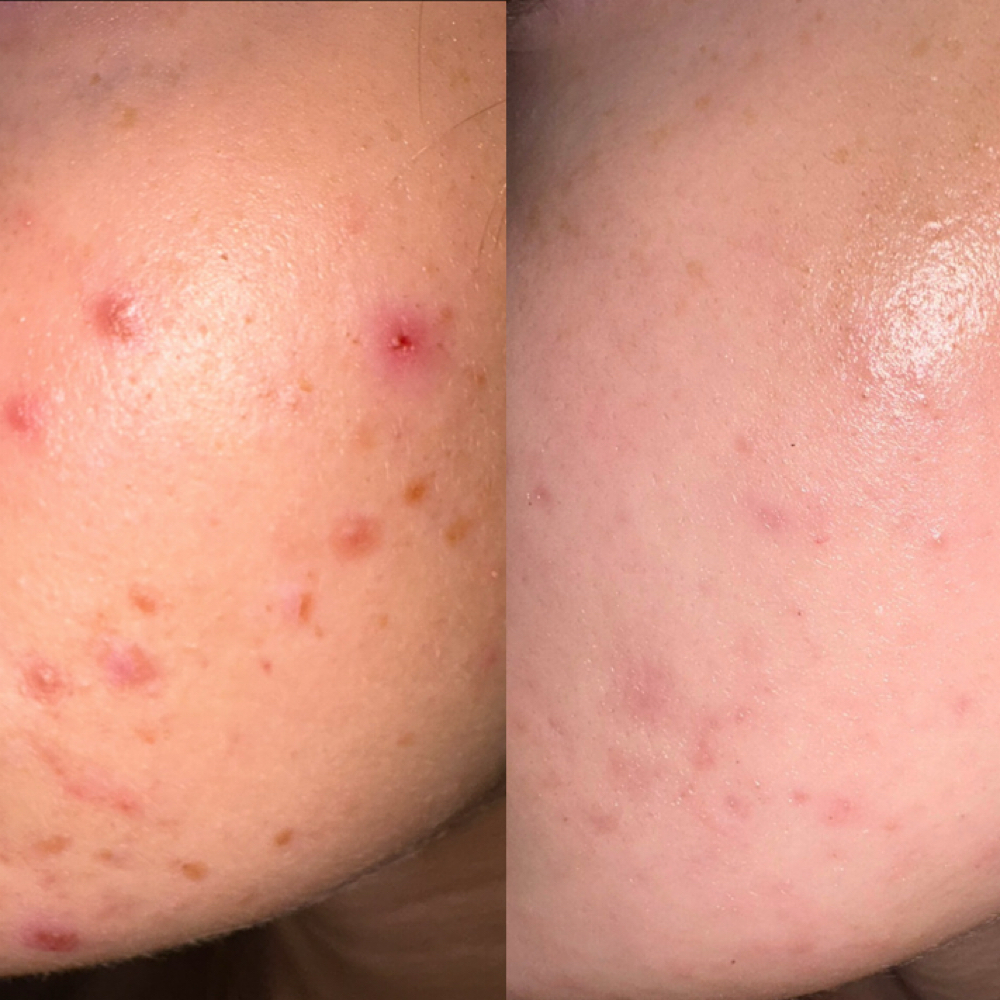 GlowByDaws ACNE Program at GlowByDawsEsthetics in Abilene, TX