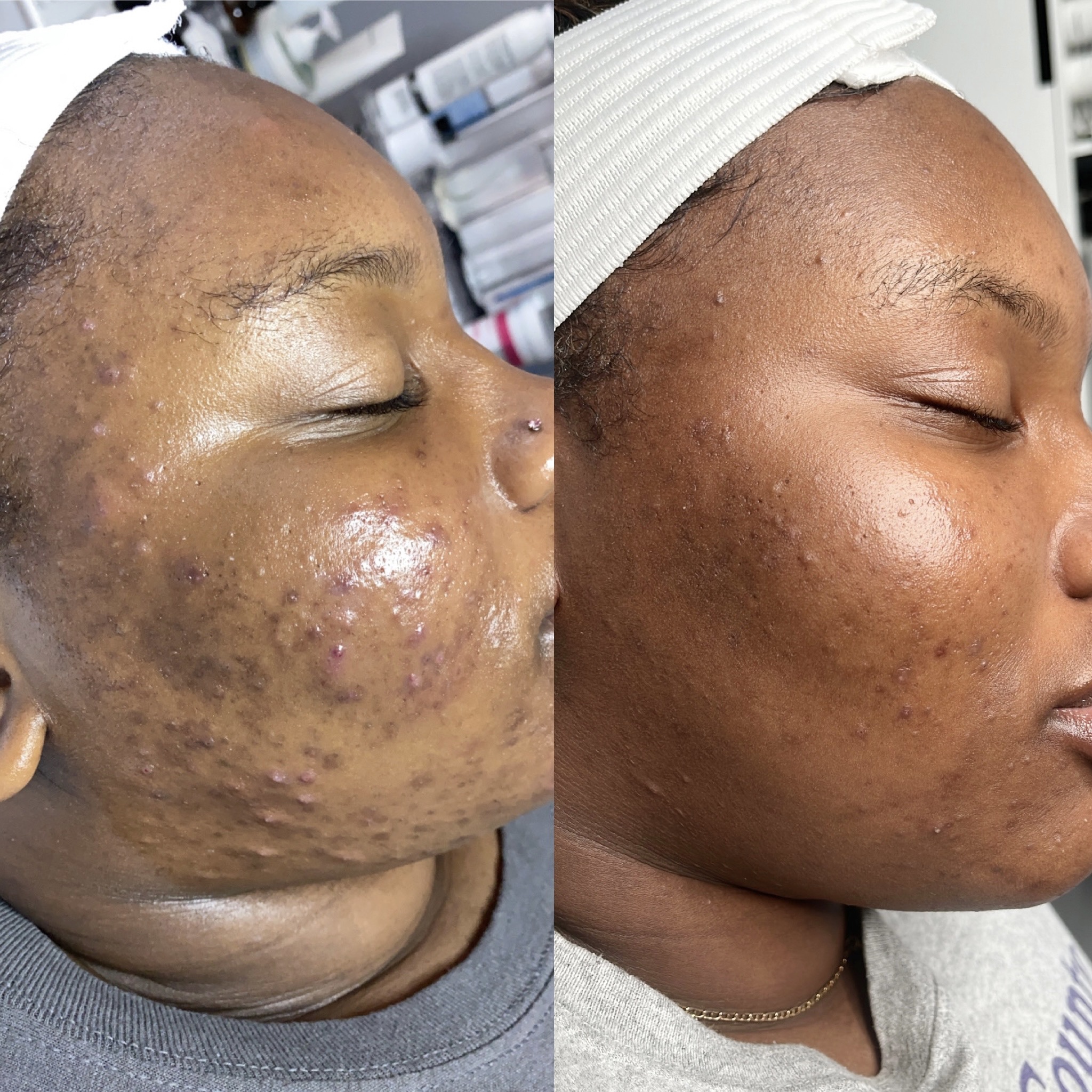 Customized Chemical Peel