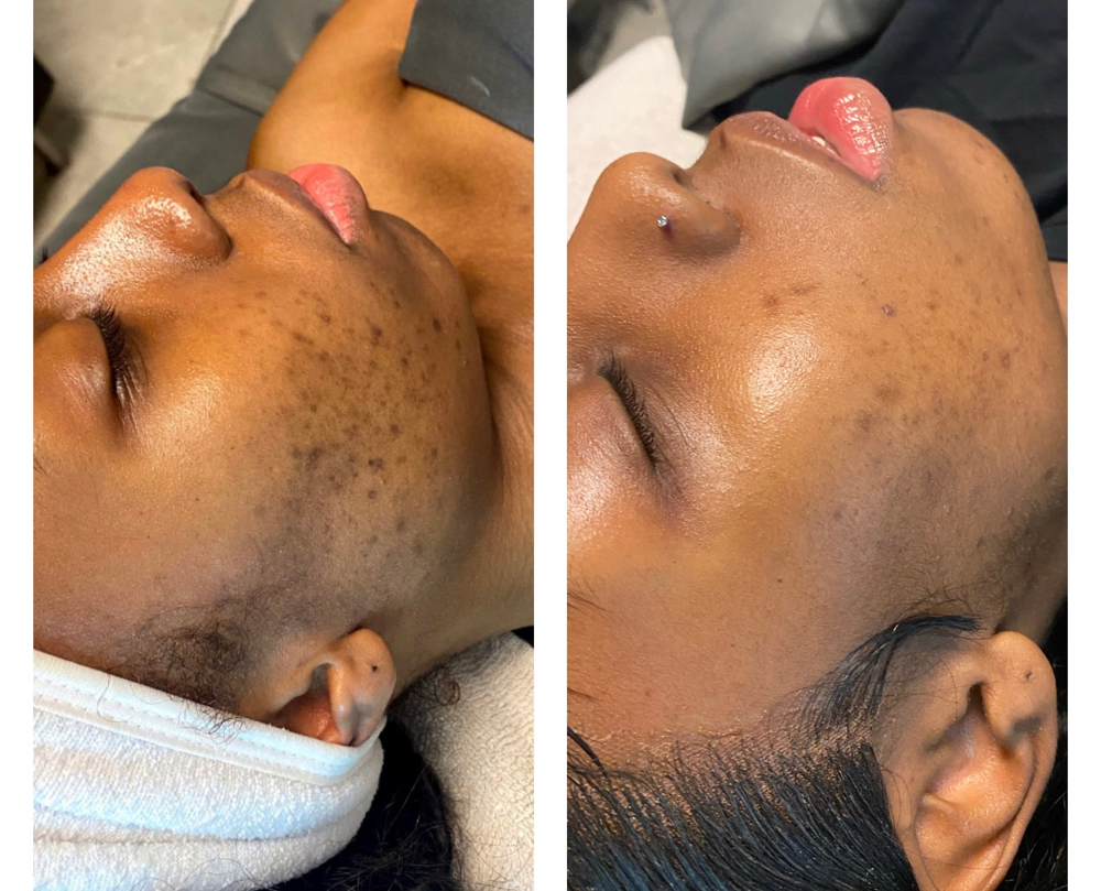 Corrective Acne Treatment Facial