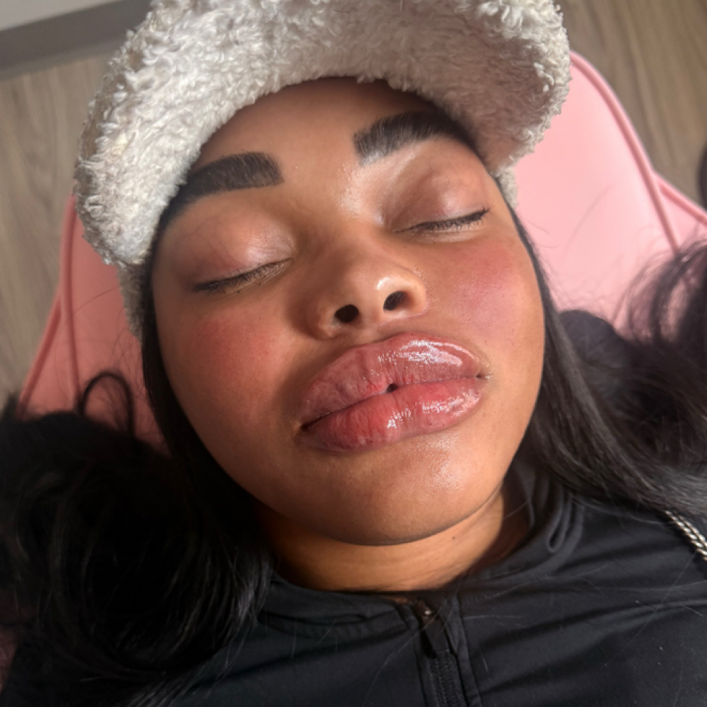 Nano Needle 2ml💉👄 at Dolls.luxury.lips in Chicago, IL