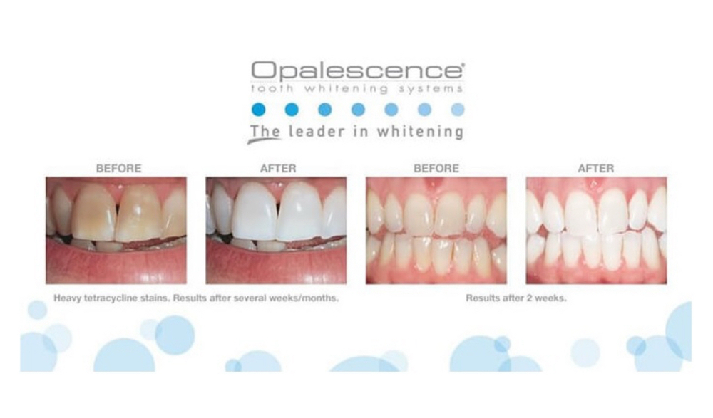 Teeth Whitening