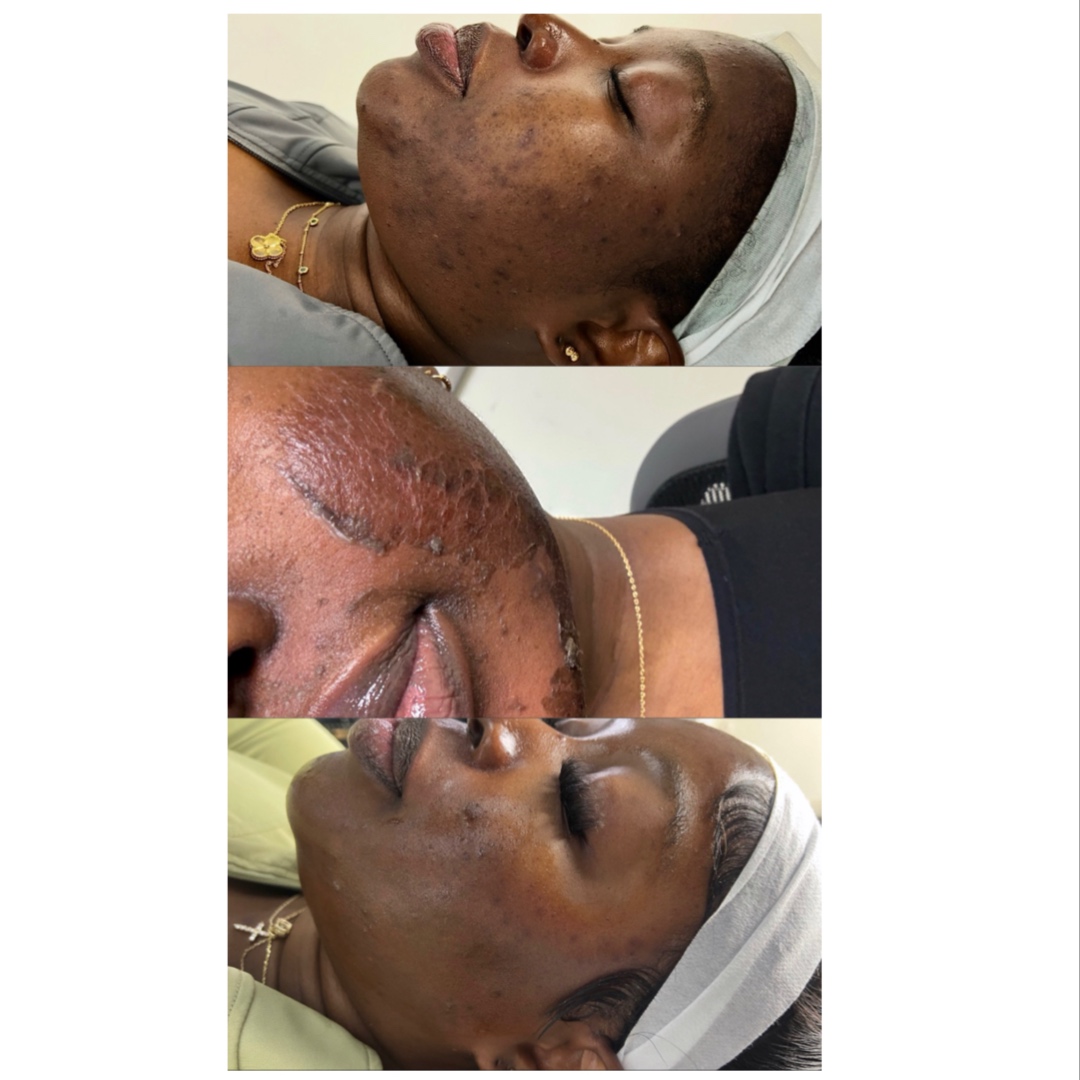 HERBAL RENEWAL PEEL (FACE) at FIRMÉ SKIN in Columbia, MD