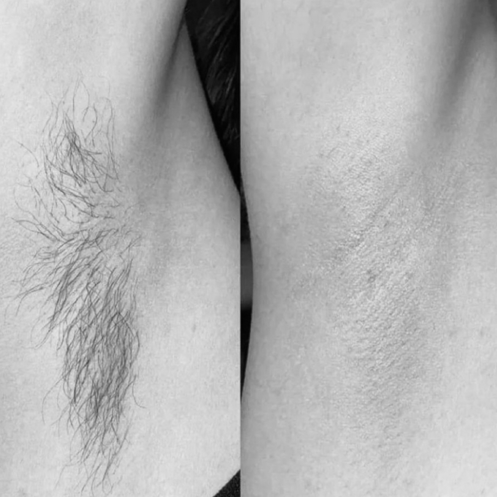 Under Arm Wax at Being Refined Aesthetics & Wellness in Weatherford, TX