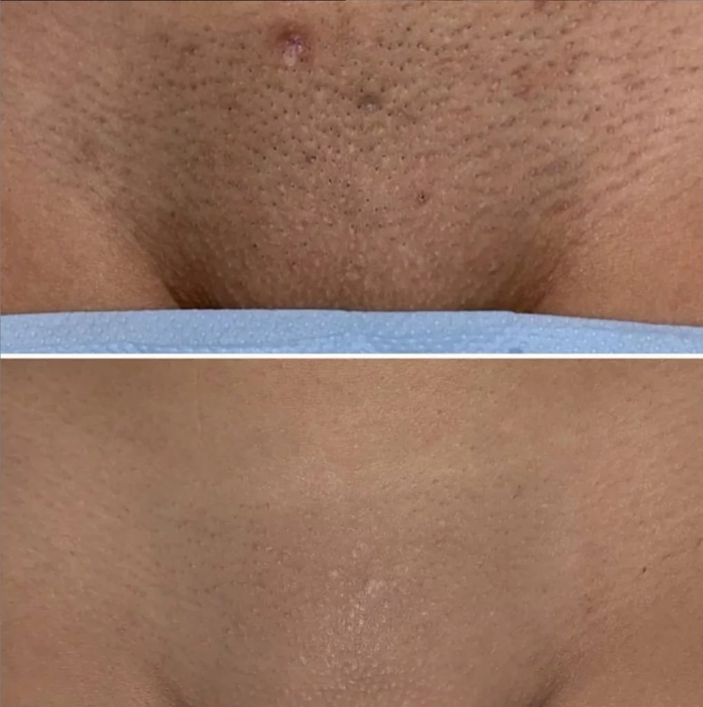 Laser- Brazilian Area