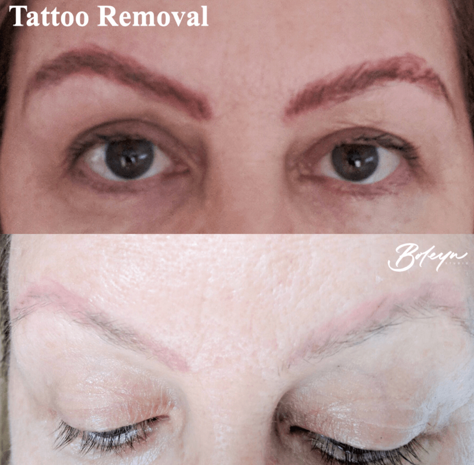PMU Saline Removal