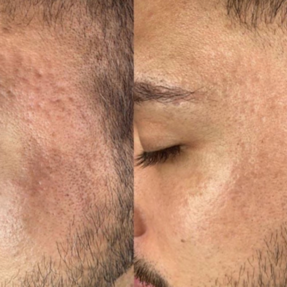 Microchanneling + Dermaplane + After Care at Beauty And Body in San Dimas, CA