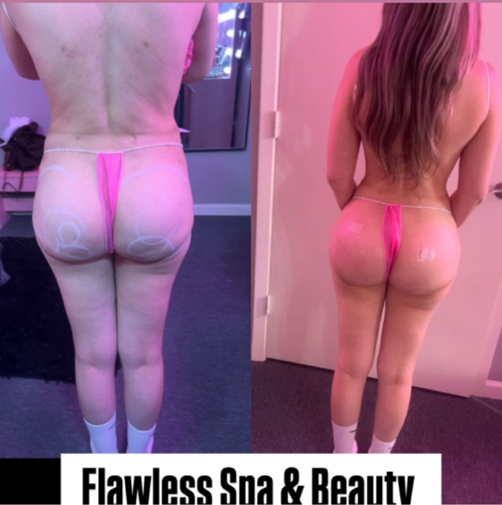 Liquid BBL at Flawless Spa & Beauty in Fort Worth, TX