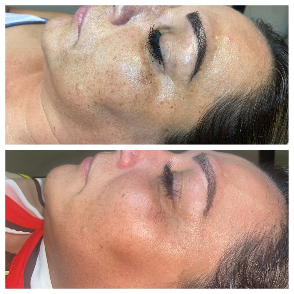 Microneedling