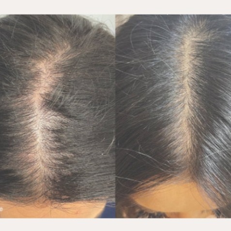 HydraScalp (Partial Scalp) at All About You Beautique in Eugene, OR