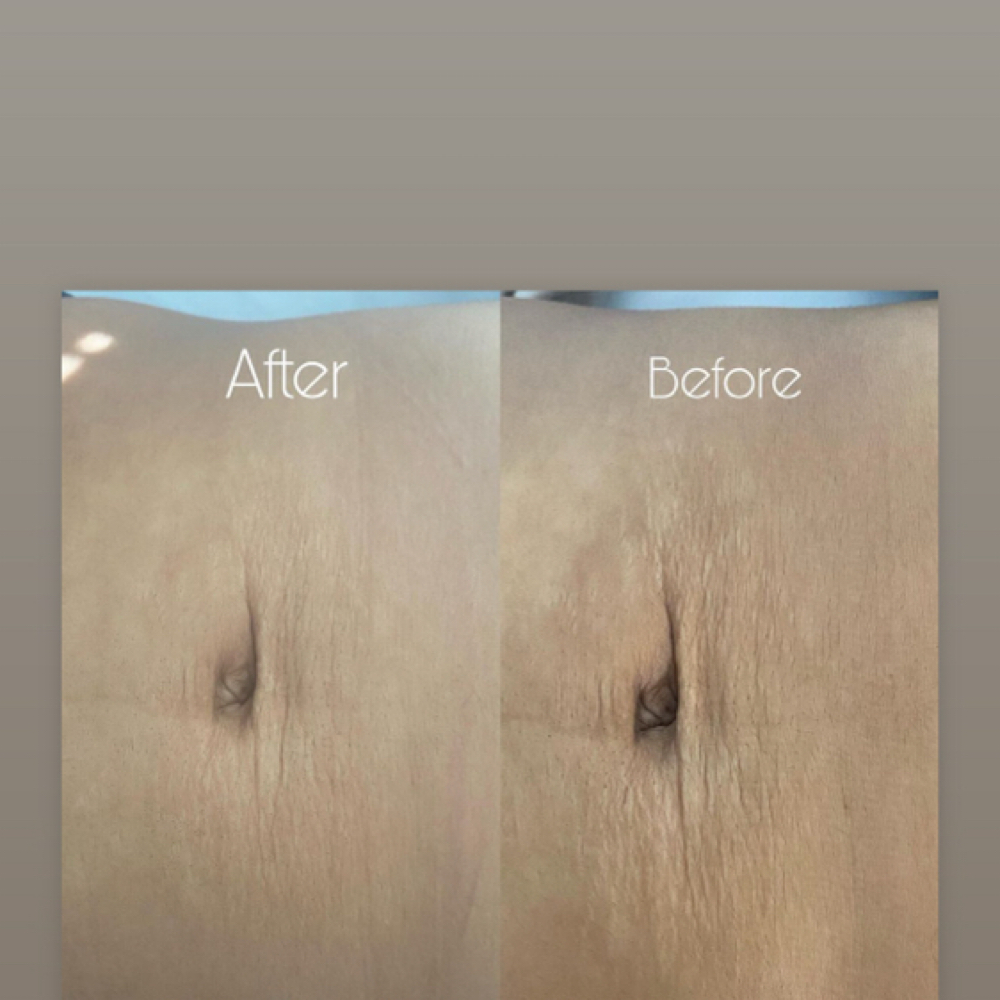 Strech Marks at Celebrity Facials LLC in Smyrna, GA