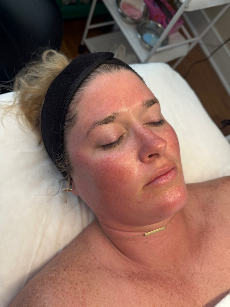 Chemical Peel at Ali Lanelle Esthetics in summerville, SC