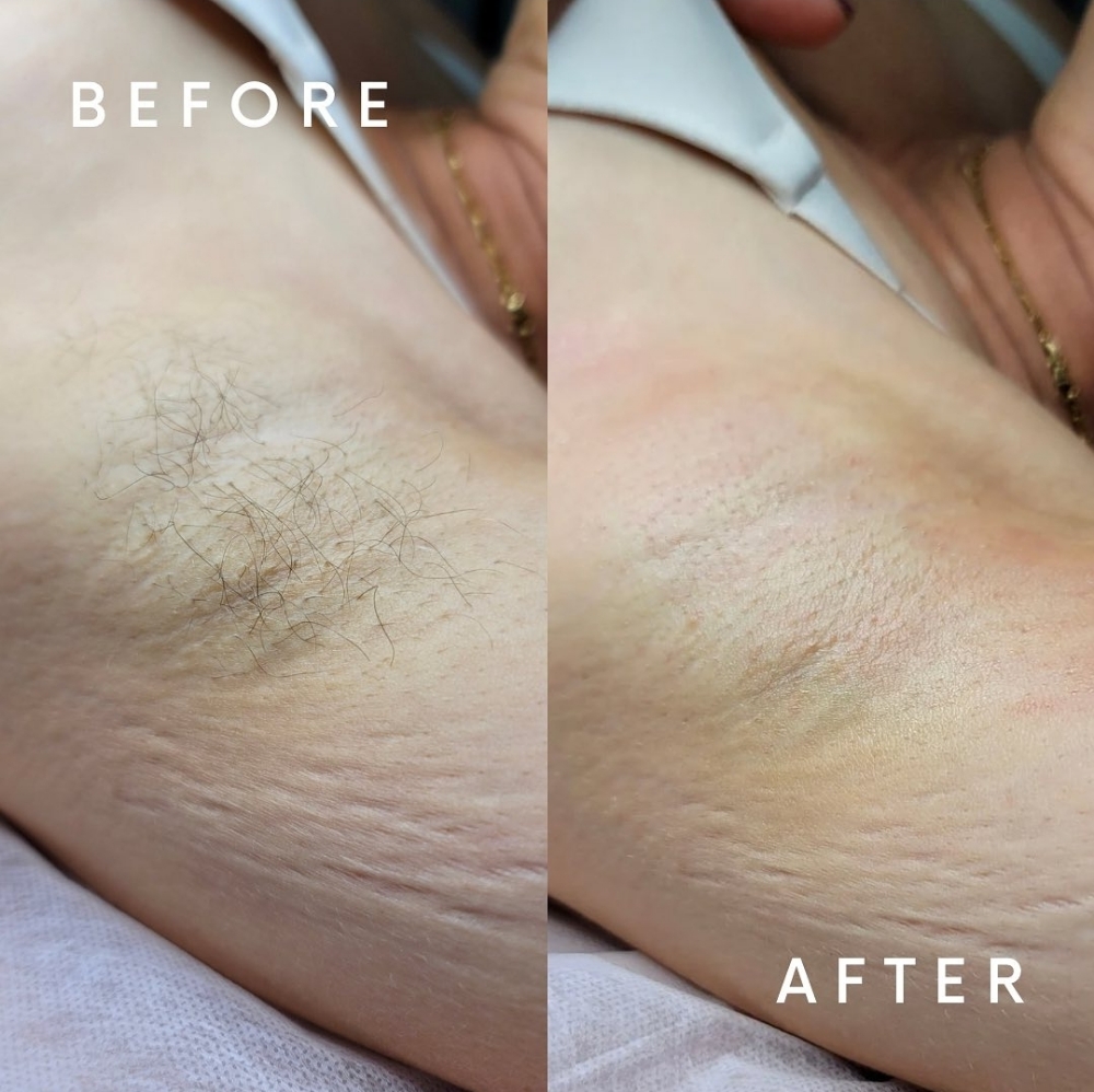 Underarm Wax at Haus Of Skin in Burleson, TX