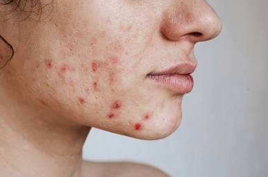 Acne Extinguisher Spot Treatment