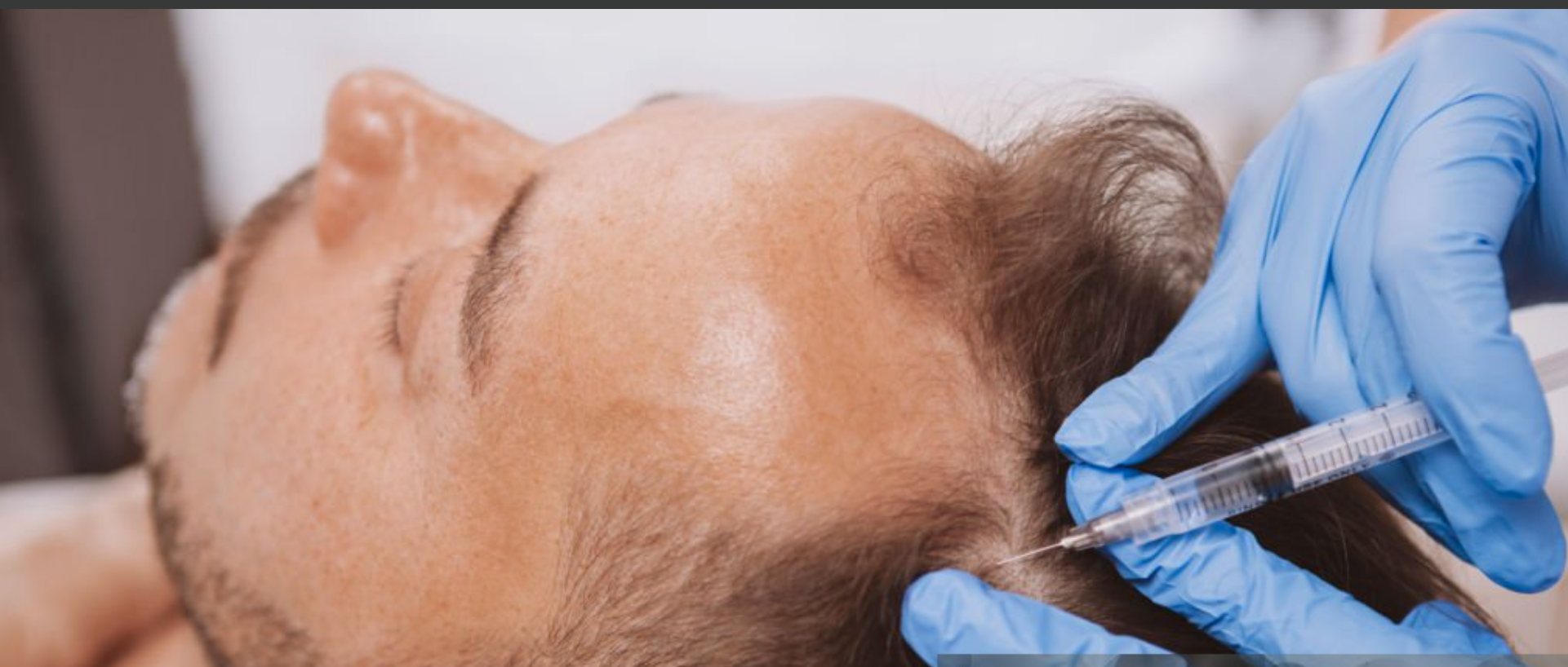 Hair PRP Injections