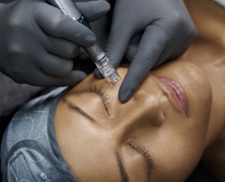 Microneedling