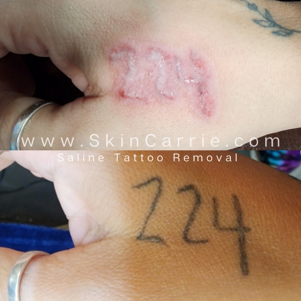 Saline Tattoo Removal at Bricktown Aesthetics & Cosmetic Tattoo Studio in Booneville, AR