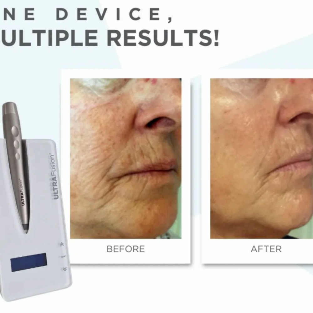 Ultrafusion Pen at Glam by Tam Aesthetics in Madison, WI