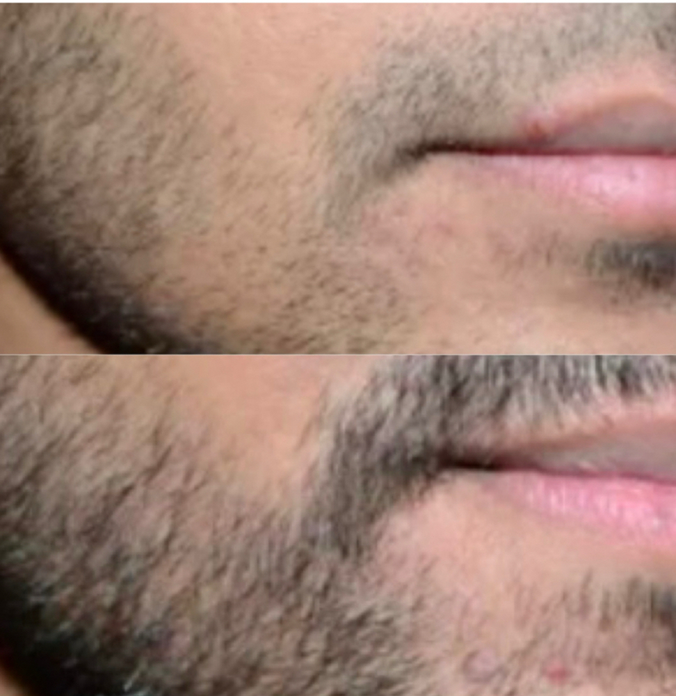 Beard follicle Stimulation