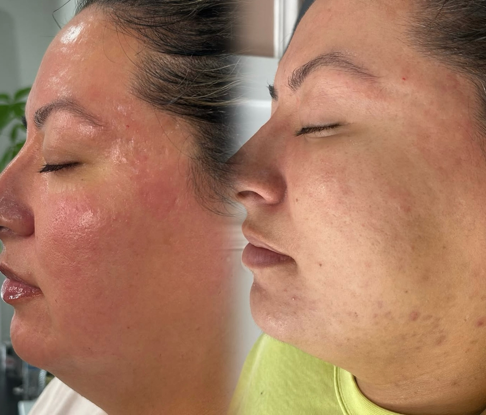 Rejuvenation Facial