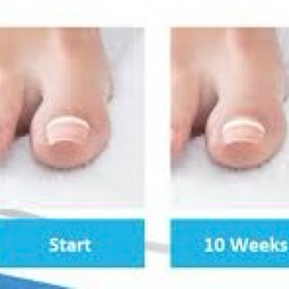 Onyfix Nail Correction at Sole Revive “Pedi Lab” in Odessa, TX