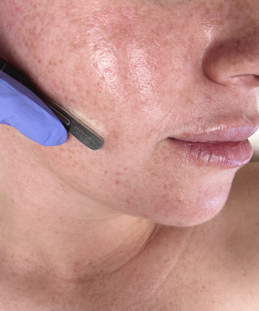 Dermaplane Neck/decollete Add-on