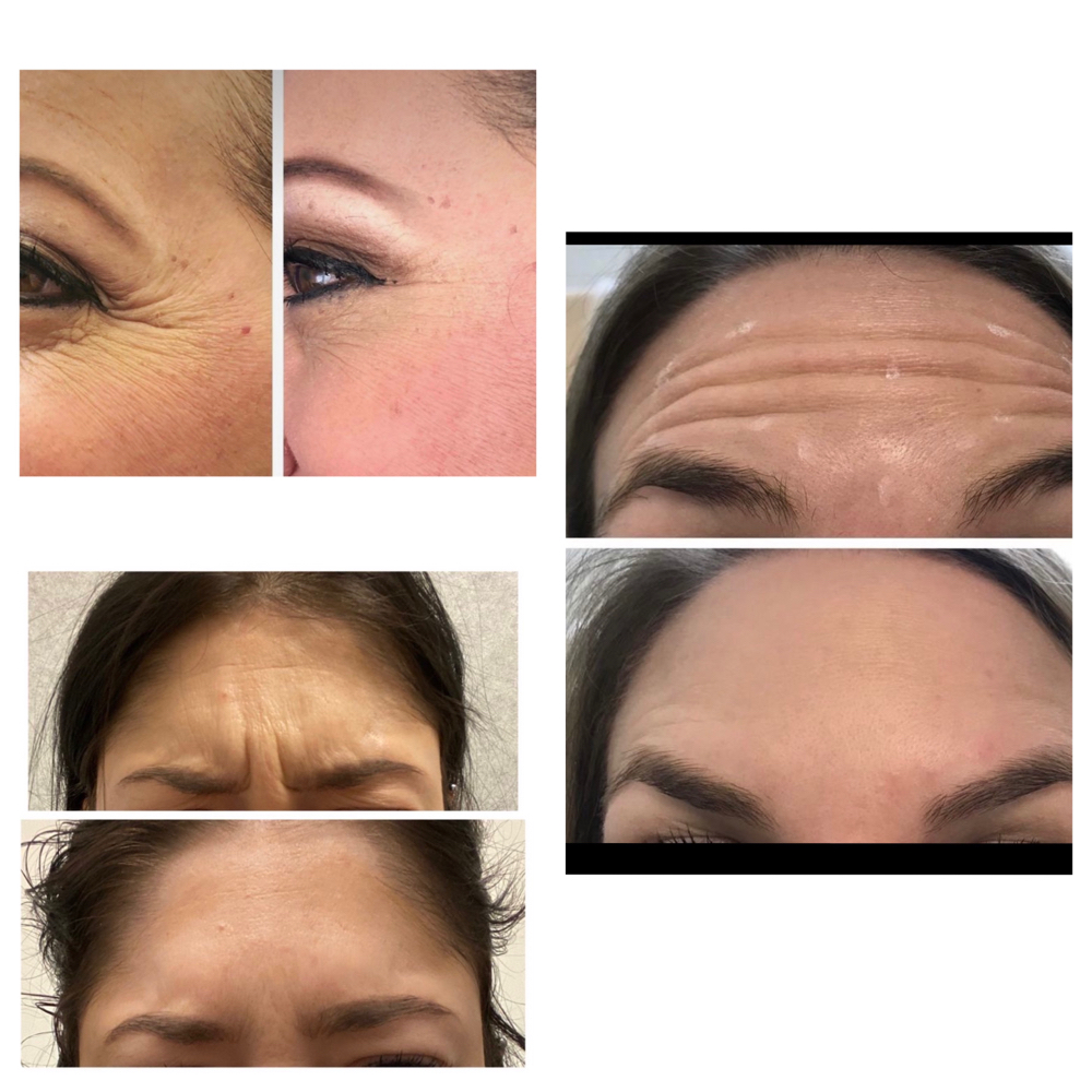 Botox (Newtox) $10 Per Unit