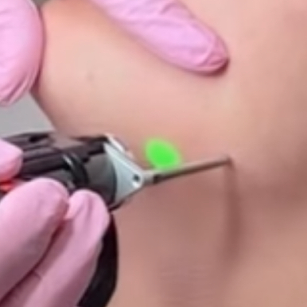 Laser Hair Removal-Facial Hair at Erika’s Beauty Lab in Littleton, CO