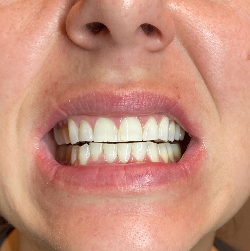 Teeth Whitening S4S