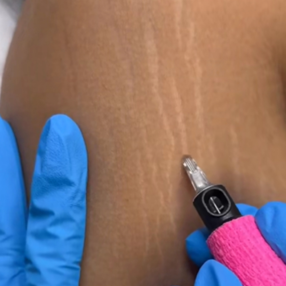 Strech Mark / Scar Rejuvenation at Magnolia House Of Beauty in El Paso, TX