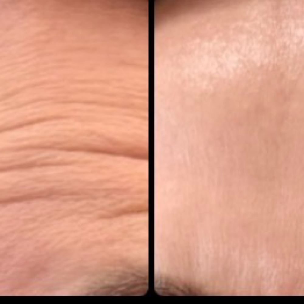 Dysport/Letybo® Wrinkle Relaxer- WA at Unmasked Aesthetics in Clackamas, OR