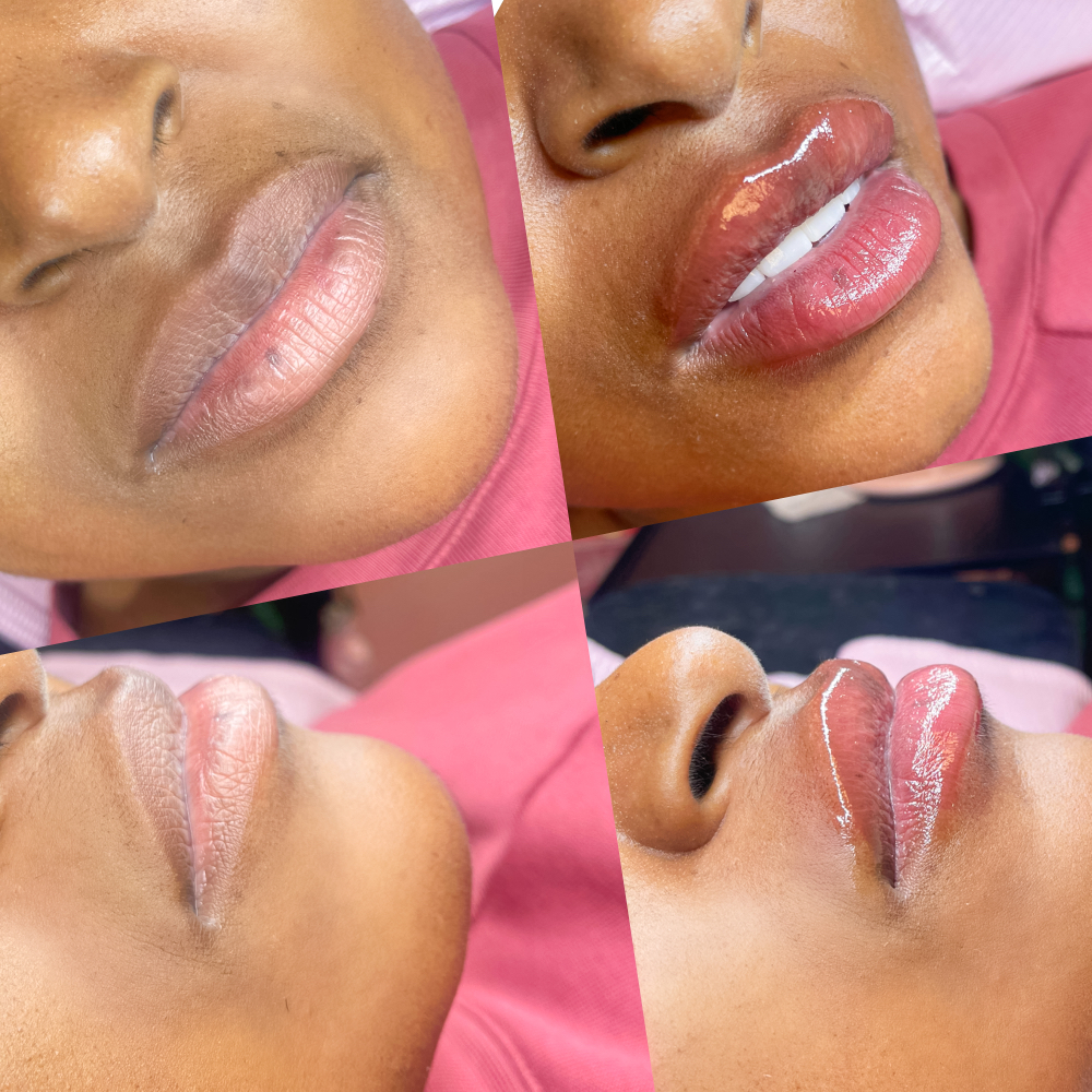 Lip filler 2mL at Beautybarbyjp in Murfreesboro, TN