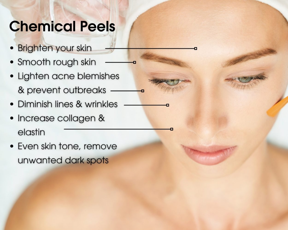 Chemical Peel (1 Appt & Products)