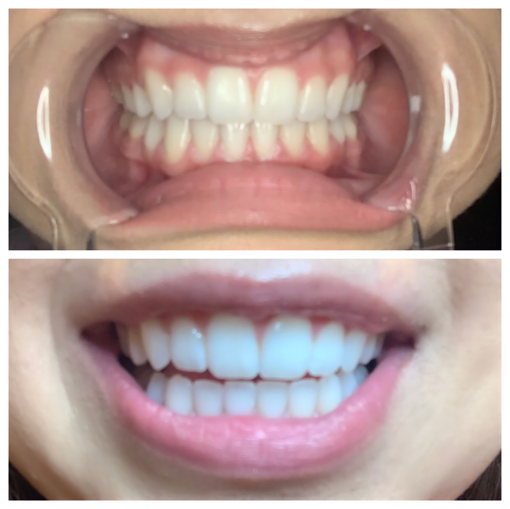 Teeth Whitening Deepstain 60 Min