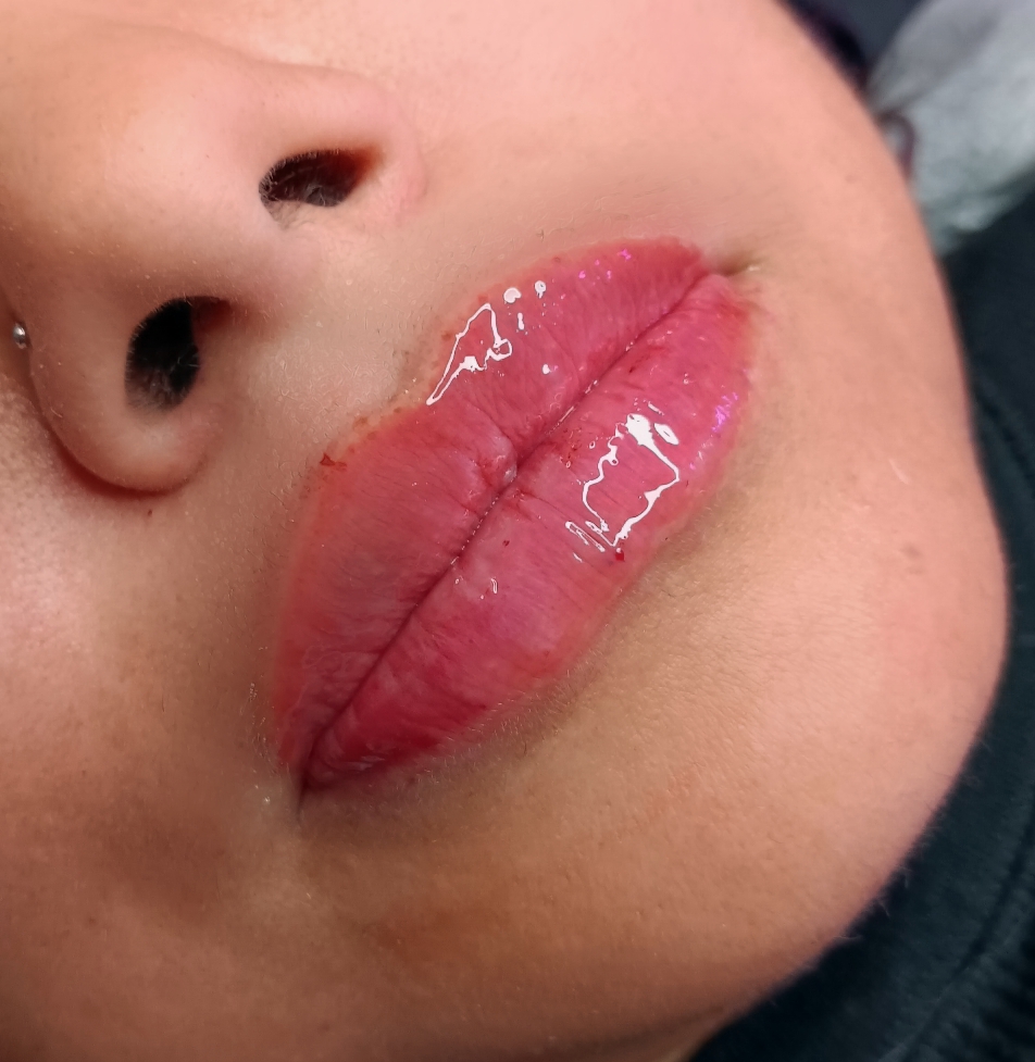💉👄1ML (Full)